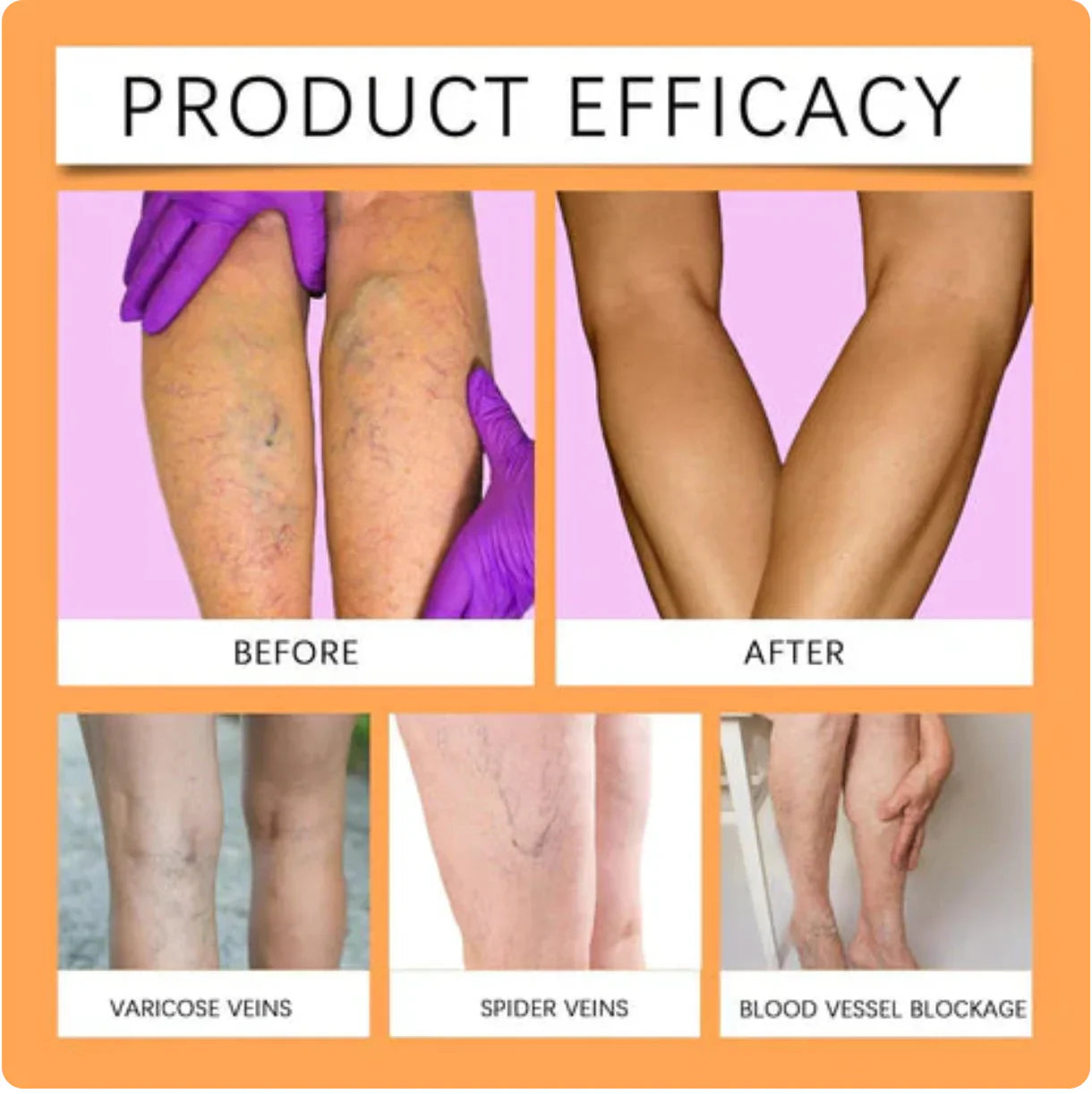 Vein Healing Varicose Veins Spray BUY 1 GET 1 Free