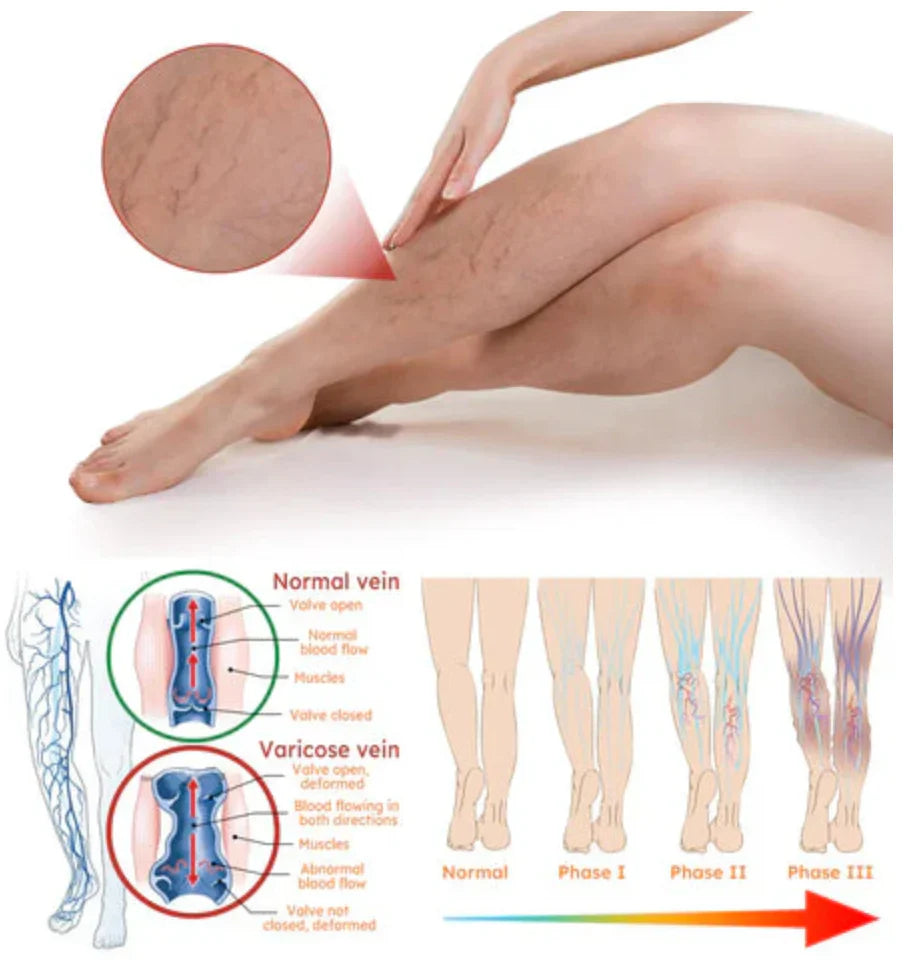 Vein Healing Varicose Veins Spray BUY 1 GET 1 Free