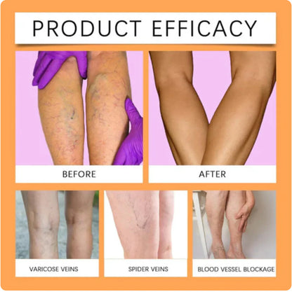 Vein Healing Varicose Veins Spray BUY 1 GET 1 Free